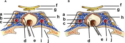 Pseudocapsule and pseudocapsule-based extracapsular resection in pituitary neuroendocrine tumors